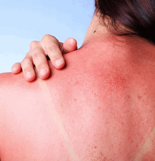 Pale skin usually burns before it tans