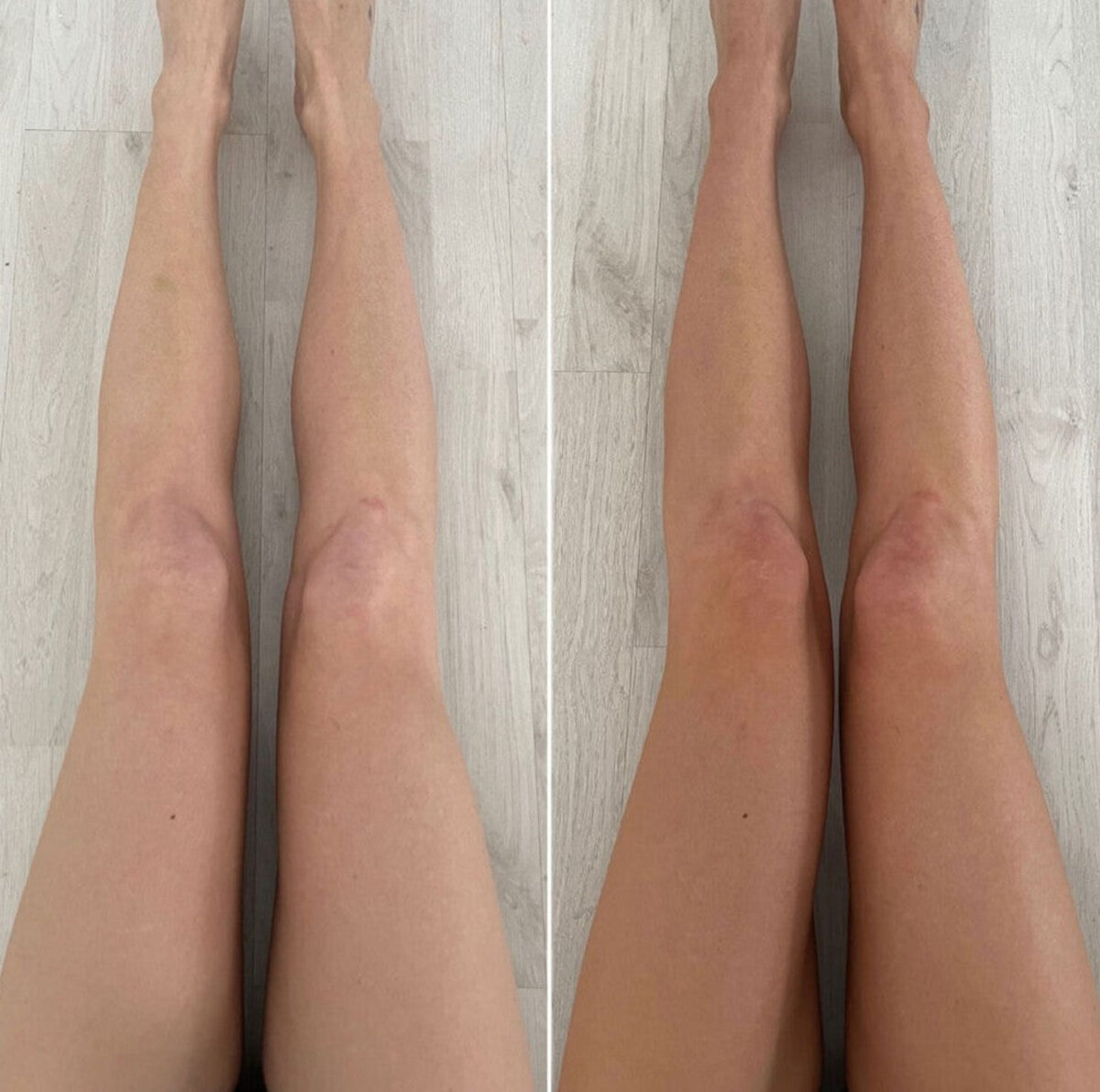 Tan legs after 32 days of Calvonic